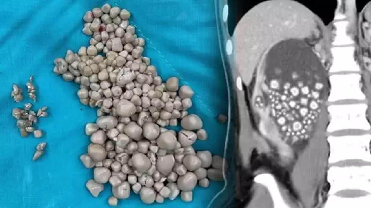 Qadının böyrəklərindən çıxanlar hər kəsi şoka saldı – FOTO