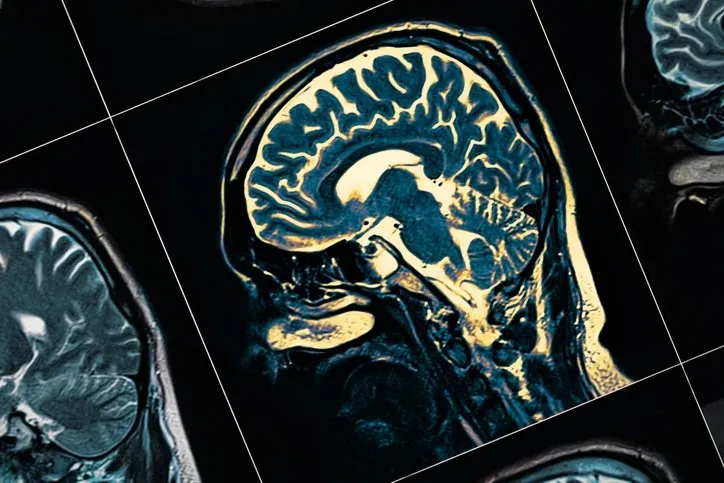 Alzheimer özünü belə göstərir: Yaddaş itkisindən əvvəl 4 siqnal