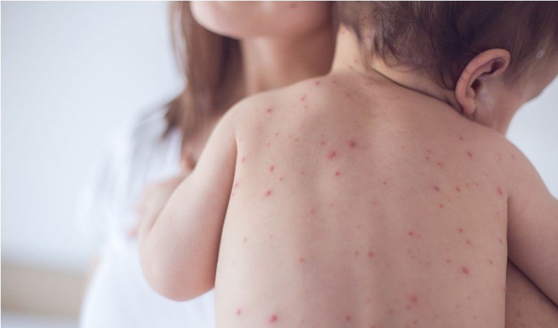 Ölkəmizdə qızılca ilə bağlı SON VƏZİYYƏT