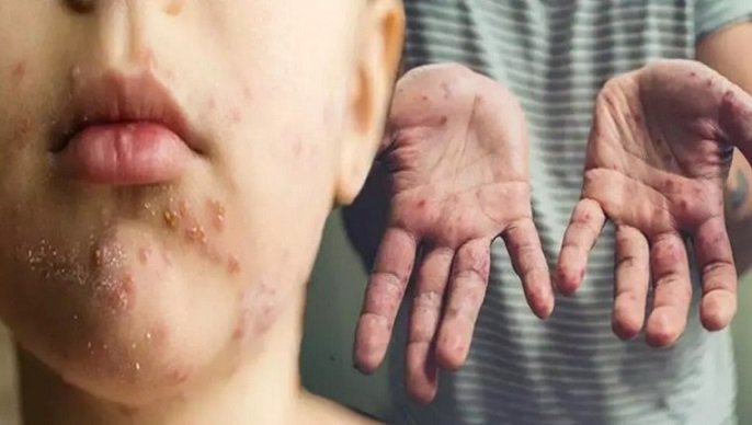 Uşaqlarda qorxulu virus: Əllərdə, ayaqlarda, ağızda səpkilər – müalicəsi yoxdur - Həkimdən SOS