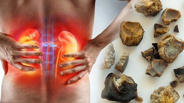 Böyrək daşlarına qarşı YENİ ÇARƏ