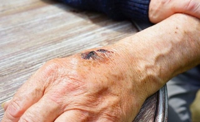 Ötən il Azərbaycanda qarayaraya yoluxanların sayı artıb
