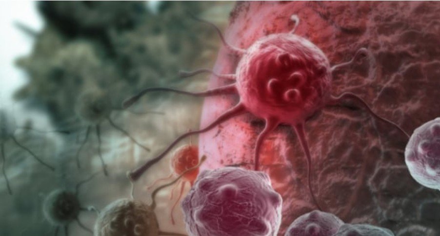 Xərçəng bədəndə belə GİZLƏNİR