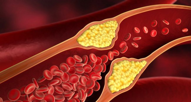 "Pis" xolesterolu 60 % azaldan dərman HAZIRLANDI