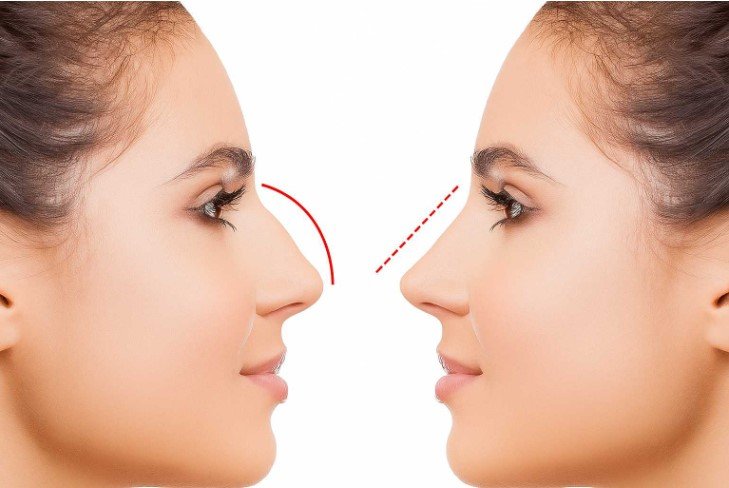 Azərbaycanda bu şəxslərə burun əməliyyatı pulsuz oldu